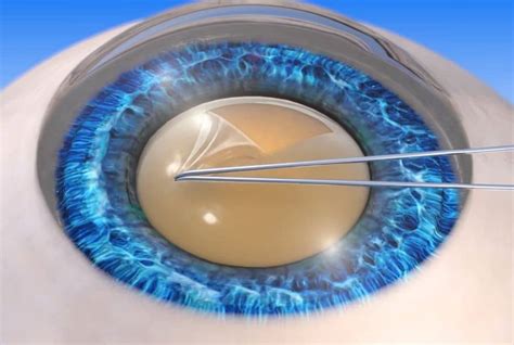 Cataract Surgery