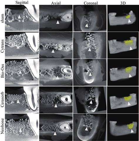 Micro Ct Analysis Of New Bone Regeneration After Weeks Of Healing