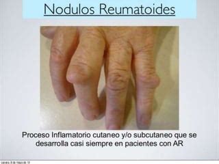 Artritis Reumatoide Manifestaciones Clinicas Ppt