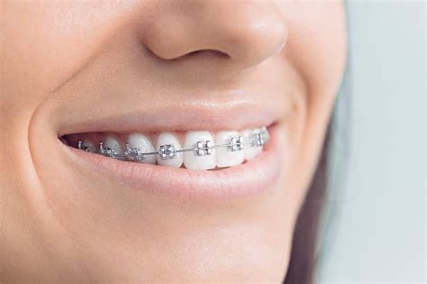 Care During Orthodontic Treatment Dentistry And Dental Implants Blog Denticare