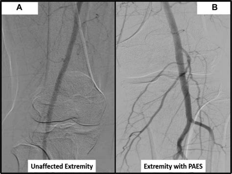 Dynamic Imaging Is The Ideal Modality For The Diagnosis Of Popliteal Artery Entrapment Syndrome