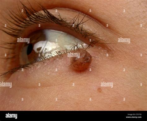 INTRADERMAL NEVUS Stock Photo - Alamy