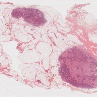 Lymph Nodes Involved In Sarcoidosis High Power Features On Higher