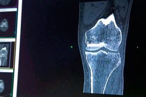 Zimmer Biomet initiates select recall of Persona Trabecular metal tibial plate sets | OrthoSpineNews