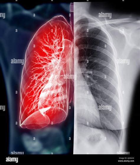 Radiografía De Tórax Con Presentación En 3d Pulmonar Para Diagnóstico