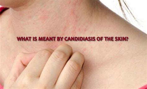 What is meant by candidiasis of the skin? - Yabibo