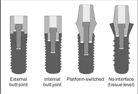 Figure 1 From Implant Abutment Connections A Review Of Biologic