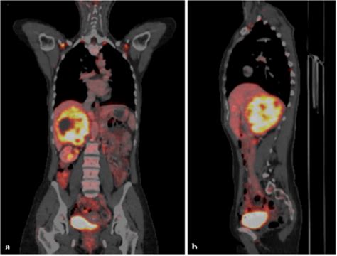 A Rare Case Of Solitary Retroperitoneal Neurofibroma Mimicking