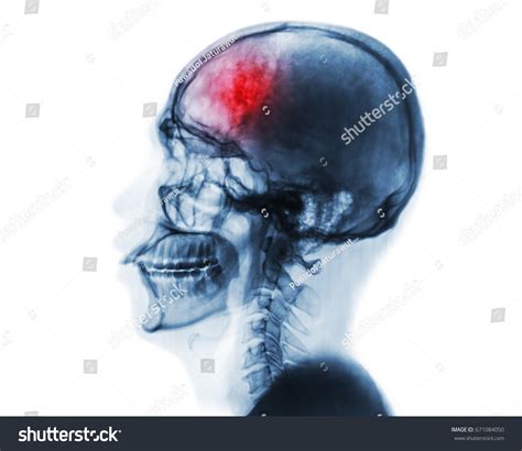 Accident Cerebraux Images Photos Et Images Vectorielles De Stock