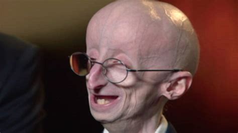 With Few Days To Live The Real Benjamin Button Gave Hope To Millions