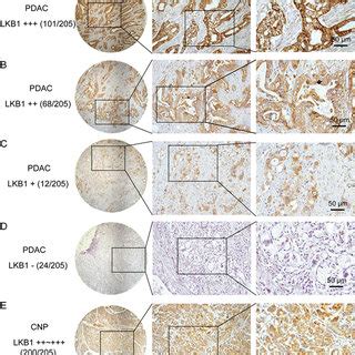 Lkb Expression In Pdac Tissue Samples A E Representative Images Of