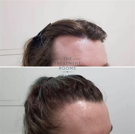 Transgender Hair Transplants Treatment Rooms London