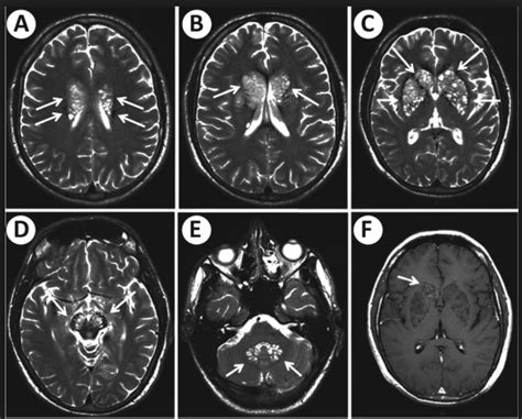 44 Cns Infections • Kang Rui Xiangs Notes