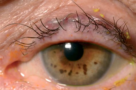 Trichiasis Treatment