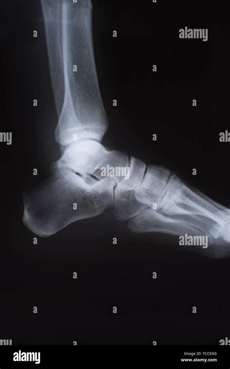 Medical X Ray Image Of Foot Radiography Stock Photo Alamy