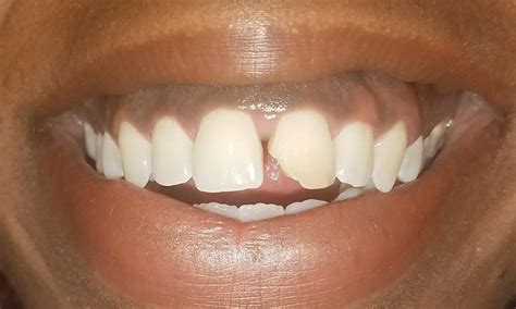 Veneers Fix Chipped Tooth Cosmetic Dentist Gretna La 70056