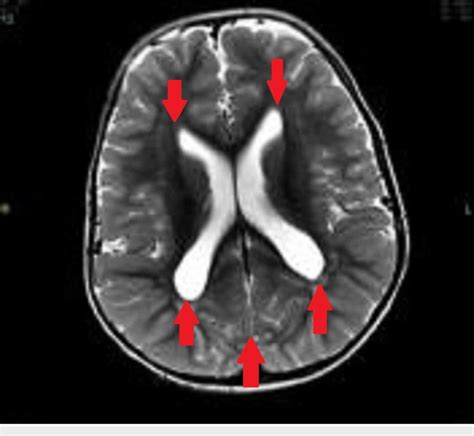 CT scan brain showing megalencephaly with enlarged ventricles and ...