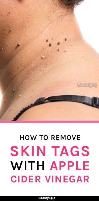 How To Remove Skin Tags With Apple Cider Vinegar