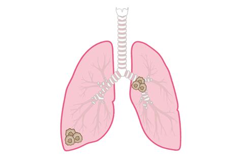 肺がんを知る｜おしえて 肺がんのコト【中外製薬】