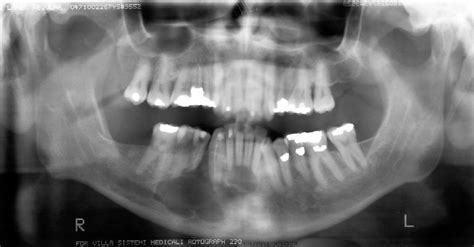 Figure From Aspectos Imagenol Gicos De Um Ameloblastoma Multic Stico