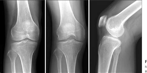 Figure 1 from Mucoid Degeneration of Both ACL and PCL | Semantic Scholar