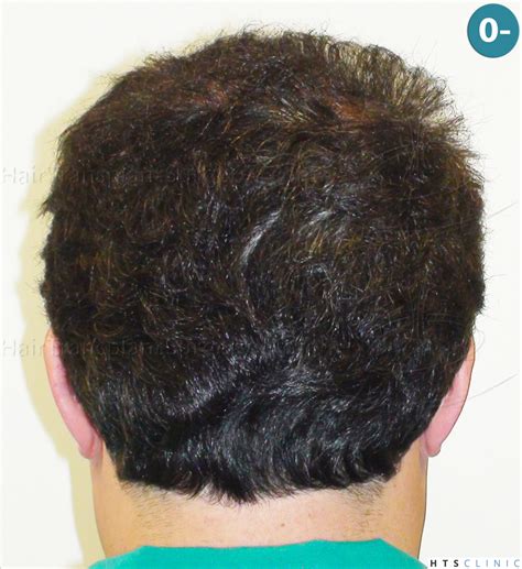 A very nice vertex work again | Hair loss Forum - Hair Transplant forums