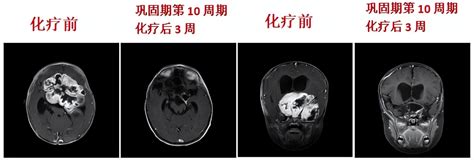 【典型病例】改良cv对于颅内巨大低级别胶质瘤的治疗效果星形细胞瘤胶质病例肿瘤 健康界