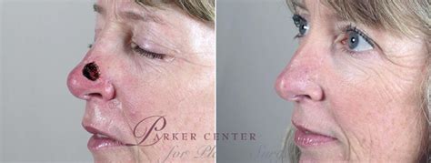 Skin Cancer Treatment Before And After Pictures Case 1051 Paramus Nj Parker Center For