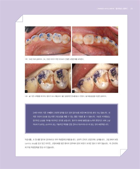 Naked Occlusion