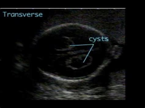 Choroid Plexus Cyst Ultrasoundpaedia