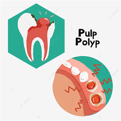 Tooth Decay Clipart Vector Deciduous Tooth Decay Pulp Polyp Deciduous