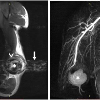 A Left B Right Sagittal Mri T Wi Of The Right Arm Panel A