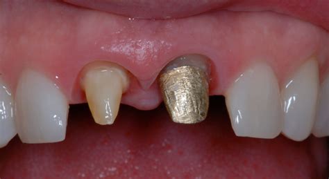 Re Treatment Involving Splinted Teeth Rick Glassman Dds Maafe