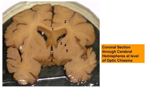 Cerebrum Sections For Revision Ppt