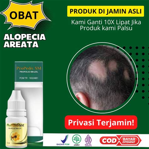 Jual Propolis Sm Obat Rambut Pitak Penumbuh Rambut Botak Koin Di Kepala