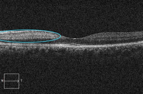 Macular OCT Interpretation: Course 401 - EyeCarePD