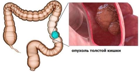 Рак толстой кишки первые симптомы признаки и лечение