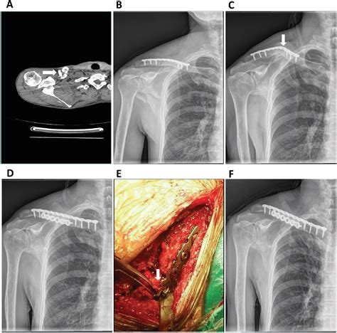 Figure From Clavicle Nonunion And Plate Breakage After Locking