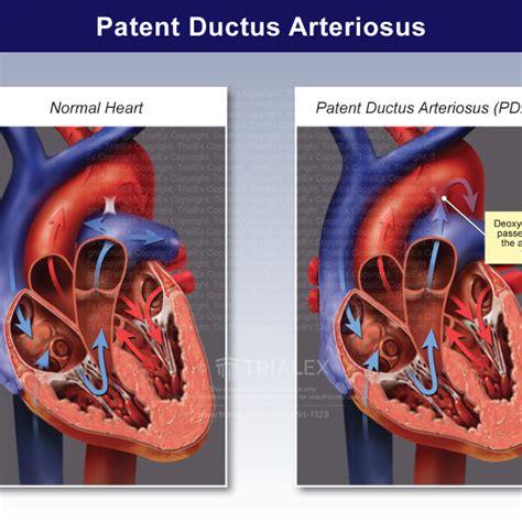 Patent Ductus Arteriosus Animation