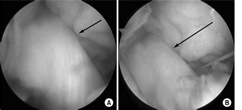 Figure From Avulsion Of The Femoral Attachment Of Anterior Cruciate