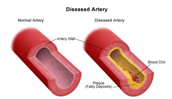 Carotid Artery Stenosis India,Carotid Artery Stenosis Treatment India ...