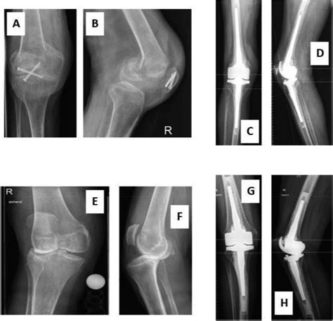 Mid Term Results Of Complex Primary Total Knee Arthroplasty Using A Rotating Hinge Implant The