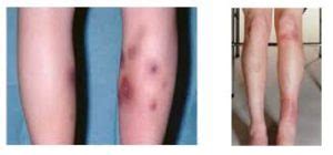 Erythema Nodosum Could Be Causing Those Nodules on Your Leg