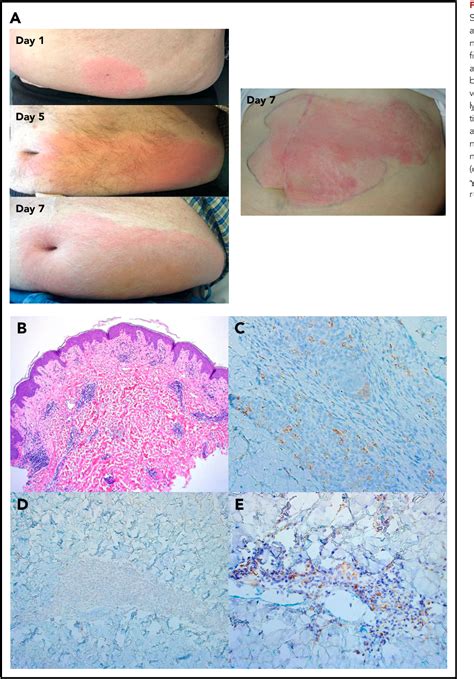 Figure From First In Human Phase Clinical Study Of The Il