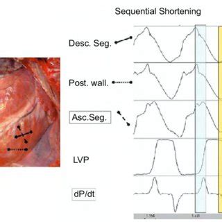 Explanation Of The Endocardial To Epicardial Activation In The Helical