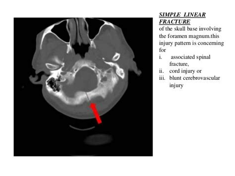 Anatomy Of Skull Fractures