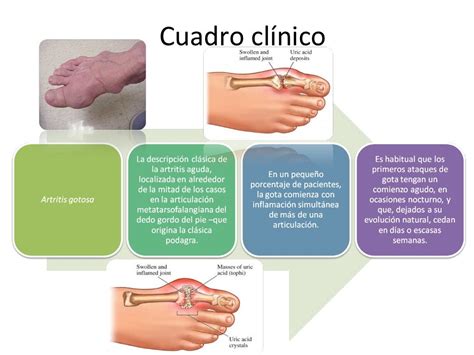 Artritis Gotosa