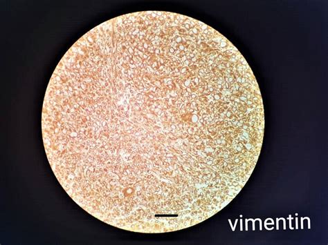 Immunohistochemical Vimentin Staining Yielding Positive Results And