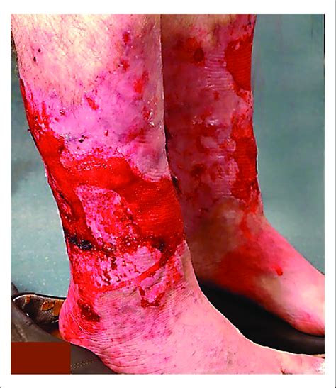 Bilateral Erythematous Plaques With Hemorrhagic And Erosive Lesions On