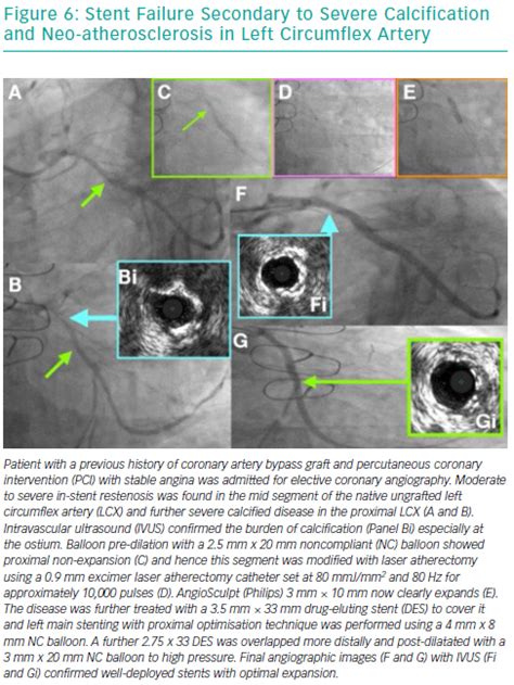 Stent Failure Secondary To Severe Calcification And Neo Atherosclerosis